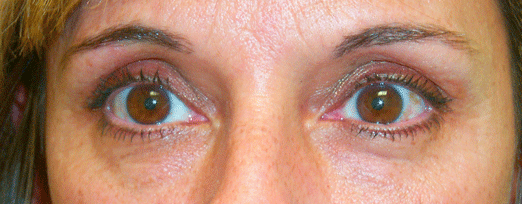 Before treatment — Age 44