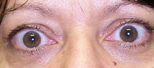 re-Operative Photograph showing upper eyelid retraction