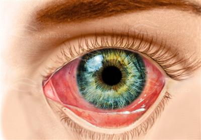 Conjunctivitis Bacterial Viral Allergic